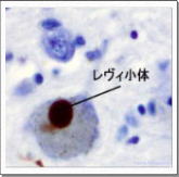 ひらめき　パーキンソン病のメカニズム