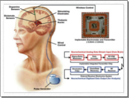 パーキンソン病・治療と療法