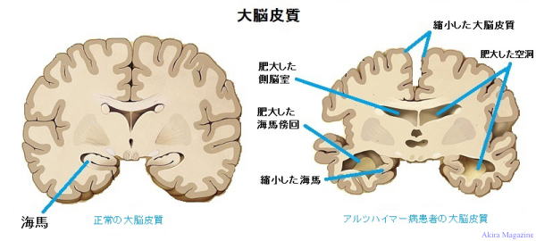 アルツハイマー病患者の大脳